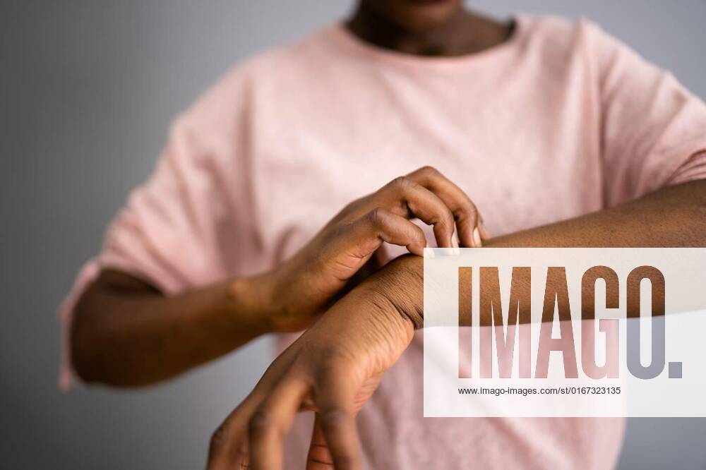 African American Woman With Itchy Skin, African American Woman With Itchy Skin. Allergy Or Psoriasis model released, Symbolfoto , 04.09.2021,