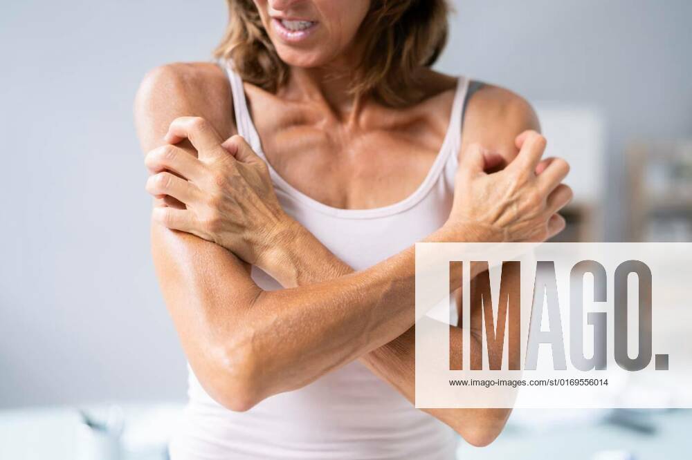 Woman With Itchy Skin, Woman With Itchy Skin. Allergy Or Psoriasis, Woman With Itchy Skin. Allergy Or Psoriasis model released, Symbolfoto , 08.07.2022,