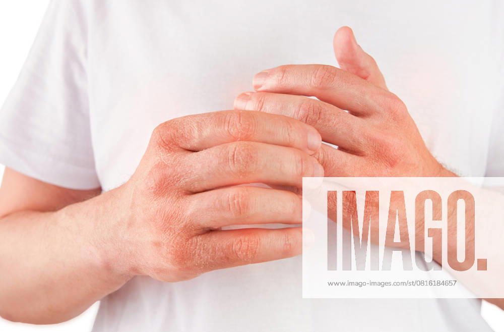 Mann kratzt oder zeigt Hände mit trockener, rissiger Haut auf weißem Hintergrund. Problem mit vielen Menschen - Ekzem auf der Hand, Allergien oder trockene Haut. Konzept der Gesundheitsfürsorge. Nahaufnahme. Man scratches or shows hands with dry, cracked skin on white backgrounds. Problem with many people - eczema on hand, allergies or dry skin. Health care concept. Close up. (License=RF)