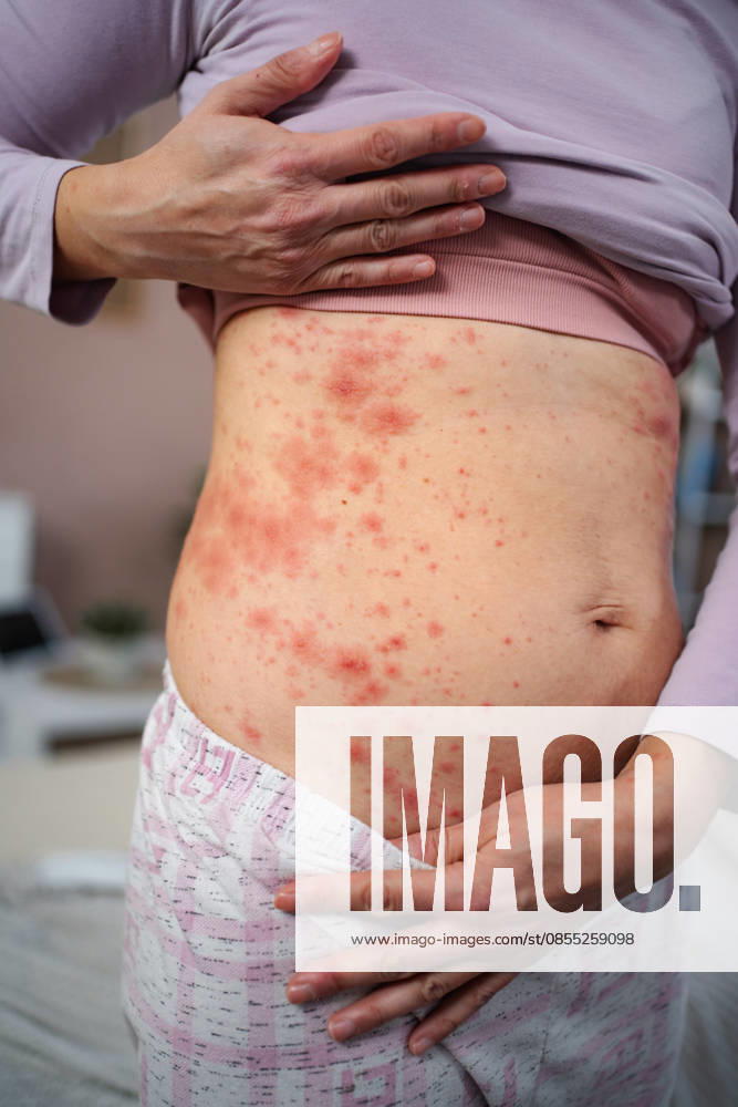 Frau mit rotem Hautausschlag am Bauch Woman feeling uncomfortable with allergic skin rash and irritation on her belly (License=RF) ,model released, Symbolfoto