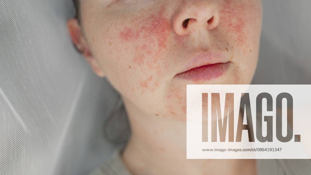 Nahaufnahme einer jungen Frau mit sichtbarer Rötung, Irritation und entzündeter Textur der Gesichtshaut. Konzept von Hautpflegeproblemen und dermatologischer Behandlung. Natürliche Hautunreinheiten, Schönheit und Gesundheit Close-up young woman with visible facial skin redness, irritation, and inflamed texture. Concept of skincare problems and dermatology treatment. Natural skin imperfections, beauty, and healthcare