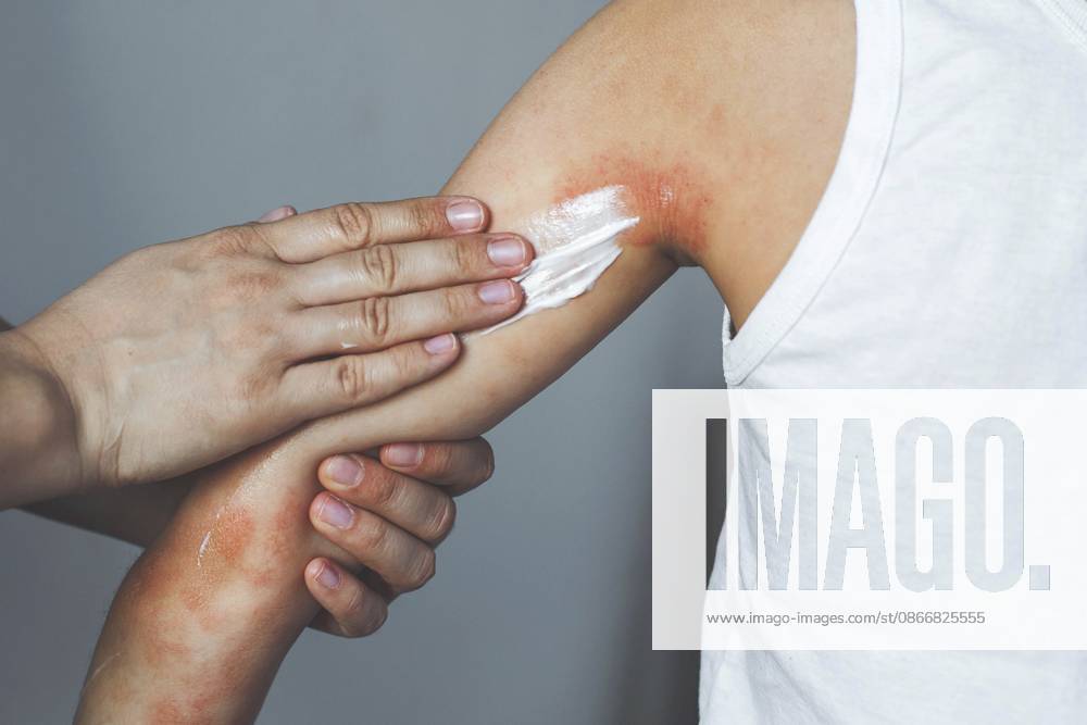 Parts of parents, the beruhigend cream on the inded skin at arm a kind, the under a strong schub of atopical dermatitis eczem, medical skin care, pädiatrische Dermatology, linderung von Allergiesymptomen and heilungs Elternteil, das beruhigende Creme auf die entzündete Haut am Arm eines Kindes aufträgt, das unter einem schweren Schub von atopischem Dermatitis-Ekzem leidet, medizinische Hautpflege, pädiatrische Dermatologie, Linderung von Allergiesymptomen und Heilungs